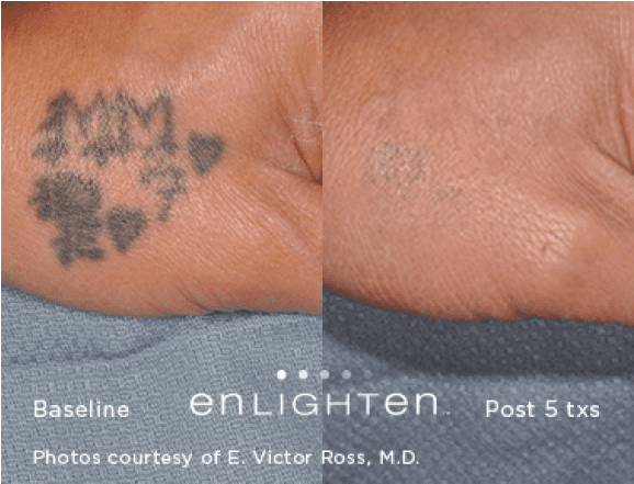 Tattoo Removal* - Tattoo (1060x440), Png Download