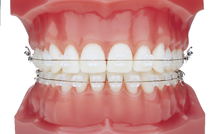 Ceramic Braces - Imágenes De Frenos Dentales (750x461), Png Download