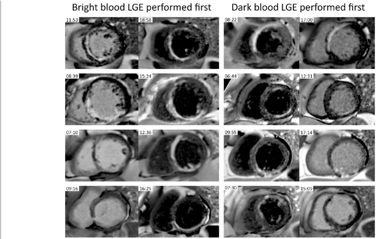 Examples Of 4 Patients That Underwent Bright Blood - Circle (850x466), Png Download