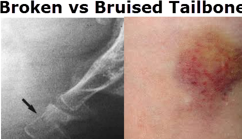 Bruised Tailbone Vs Broken Tailbone - Bruised Tailbone (477x290), Png Download