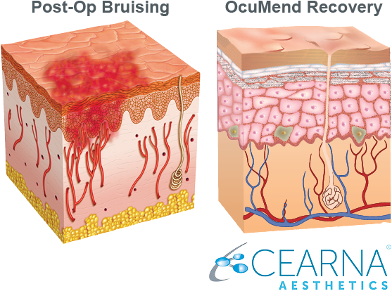 The Only Patented Bruising And Swelling Solution Backed - Skin (598x485), Png Download