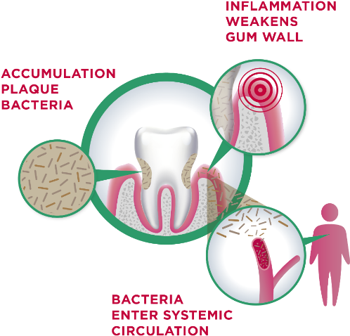 The Gum Link - Diagram (670x529), Png Download