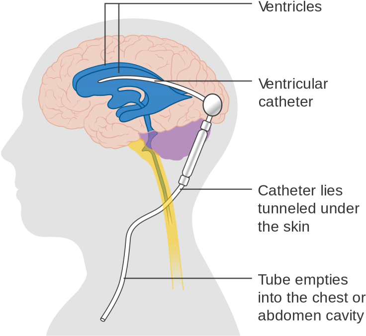 Diagram Showing A Brain Shunt Cruk - Program Valve Shunt (800x779), Png Download
