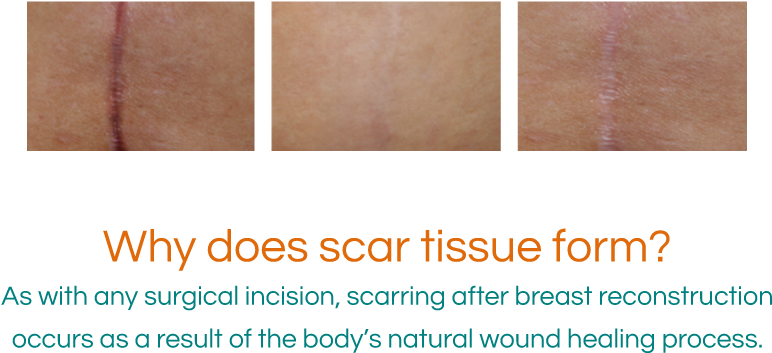 Why Does Scar Tissue Form - Incision Scar Healing Process (801x401), Png Download