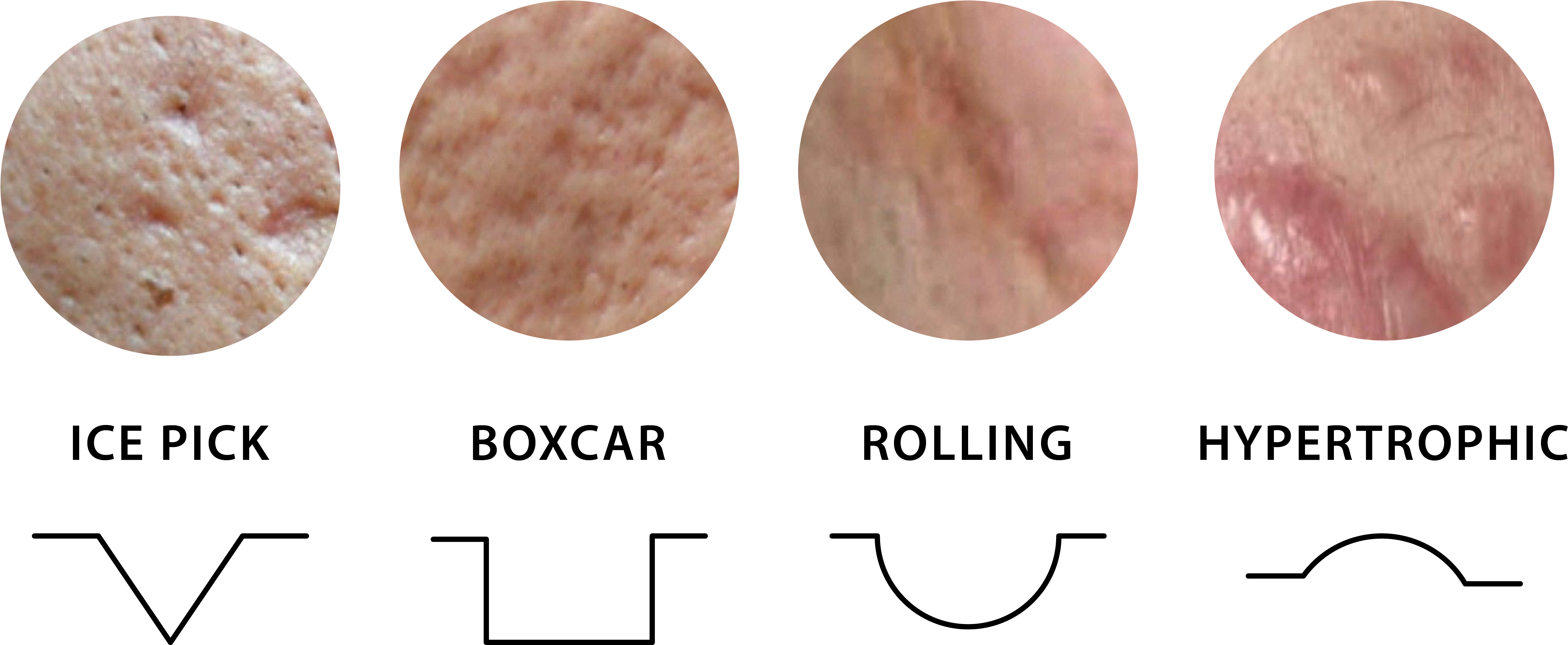 Airjet Acne Scar Treatment Shiro Aesthetic Cinic - Mettwurst (5001x2500), Png Download