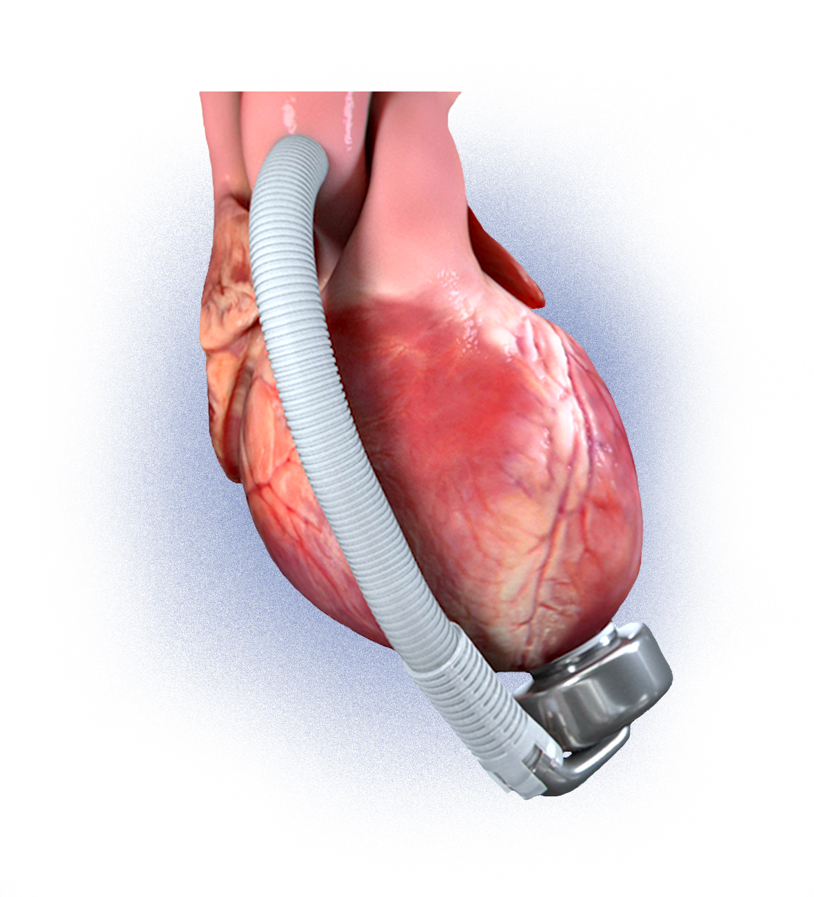 A Standard Implantation Procedure - Injury (1181x1301), Png Download