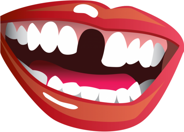 Missing Teeth Cliparts - Missing Teeth Smile Png (640x480), Png Download