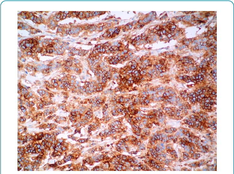 Cd 56 Stain Show Diffuse Strong Cytoplasmic Staining - Dessert (769x571), Png Download