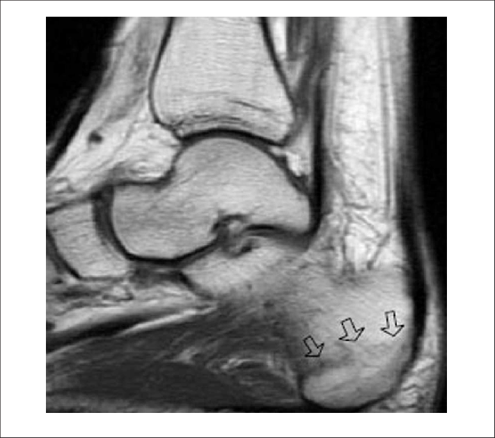 Radiograph Before Shock Wave Therapy - X-ray (711x629), Png Download