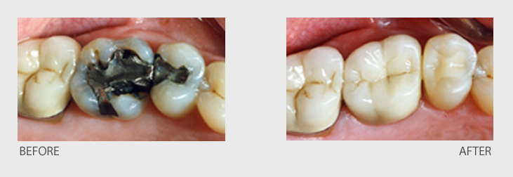 Most Often Complete Your Crown In One Visit With A - Filling Removal (731x252), Png Download