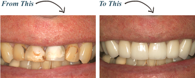 Crowns - Much Do Dental Crowns Cost (752x369), Png Download