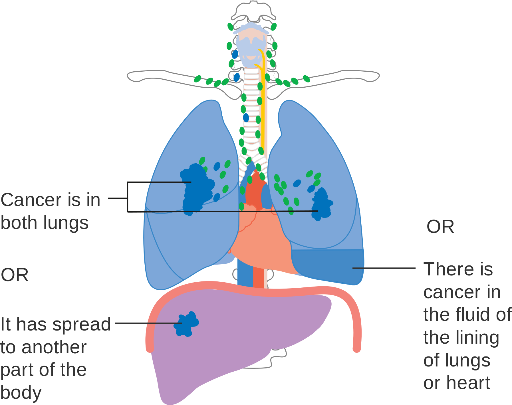 Tnm Staging Lung Cancer (2000x1633), Png Download
