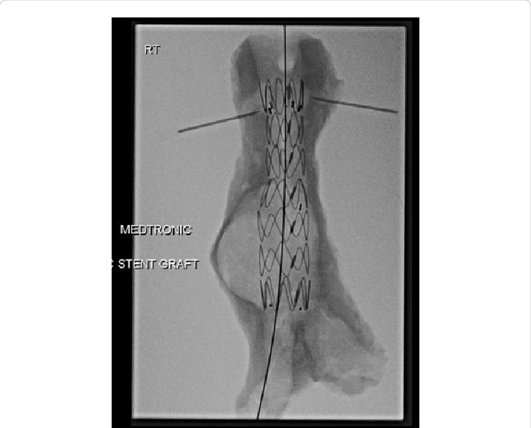 Preoperative Simulation Of Evar On An Aaa Shell - Rib (761x614), Png Download