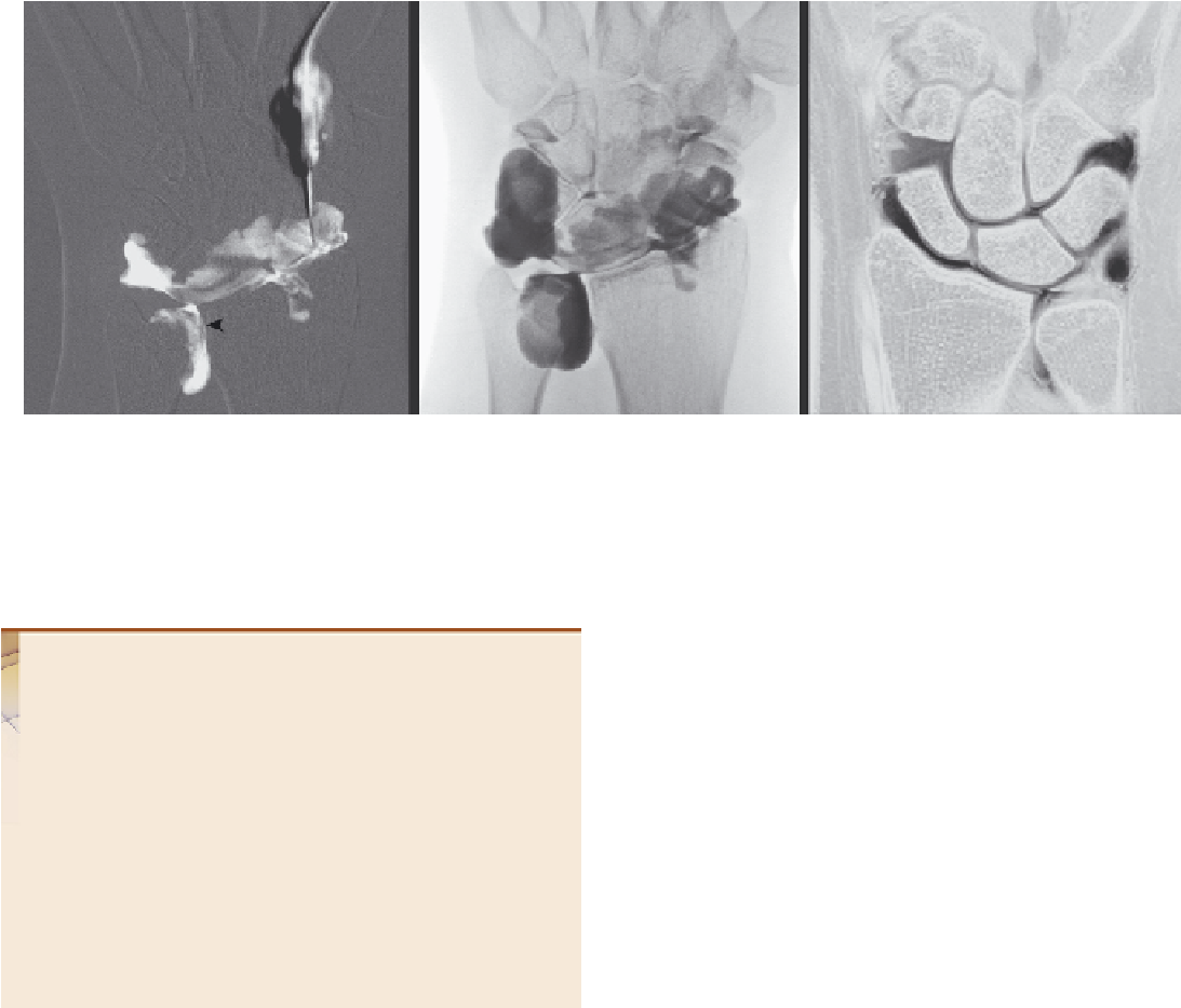 Triangular Fibrocartilage Tear Syndrome - Visual Arts (1094x962), Png Download